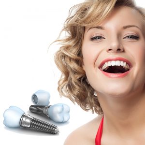 Implant_dentar