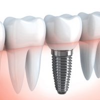 implanturi_dentare_rapide_dr.Leahu