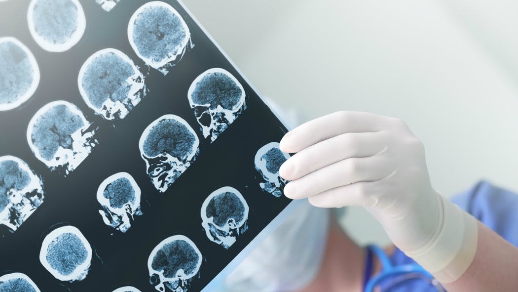 Alzheimer: un vaccin si un tratament potential datorita unei noi abordari